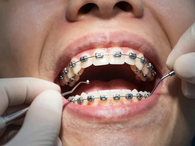 Jak fixní rovnátka pomáhají při léčení křížového skusu