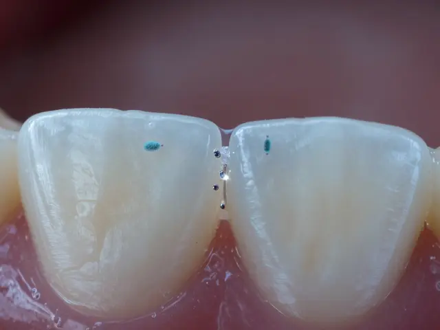 Jaký je vliv cukru na mezizubní kaz: Mechanismus, rizika a prevence